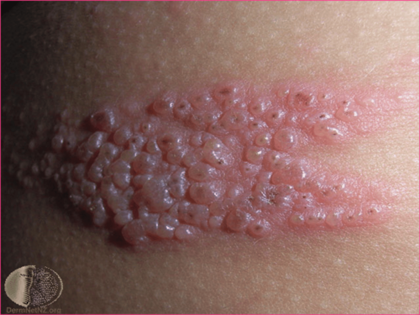 <p>lesions that are grouped <br><br>Example: Herpes simplex</p>