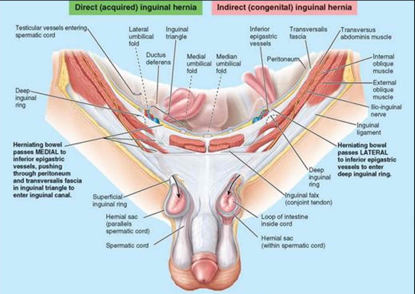 <p>Protrusions of parietal peritoneum and and viscera</p><p>- More common in males because of the passage of the spermatic cord through the inguinal canal</p>