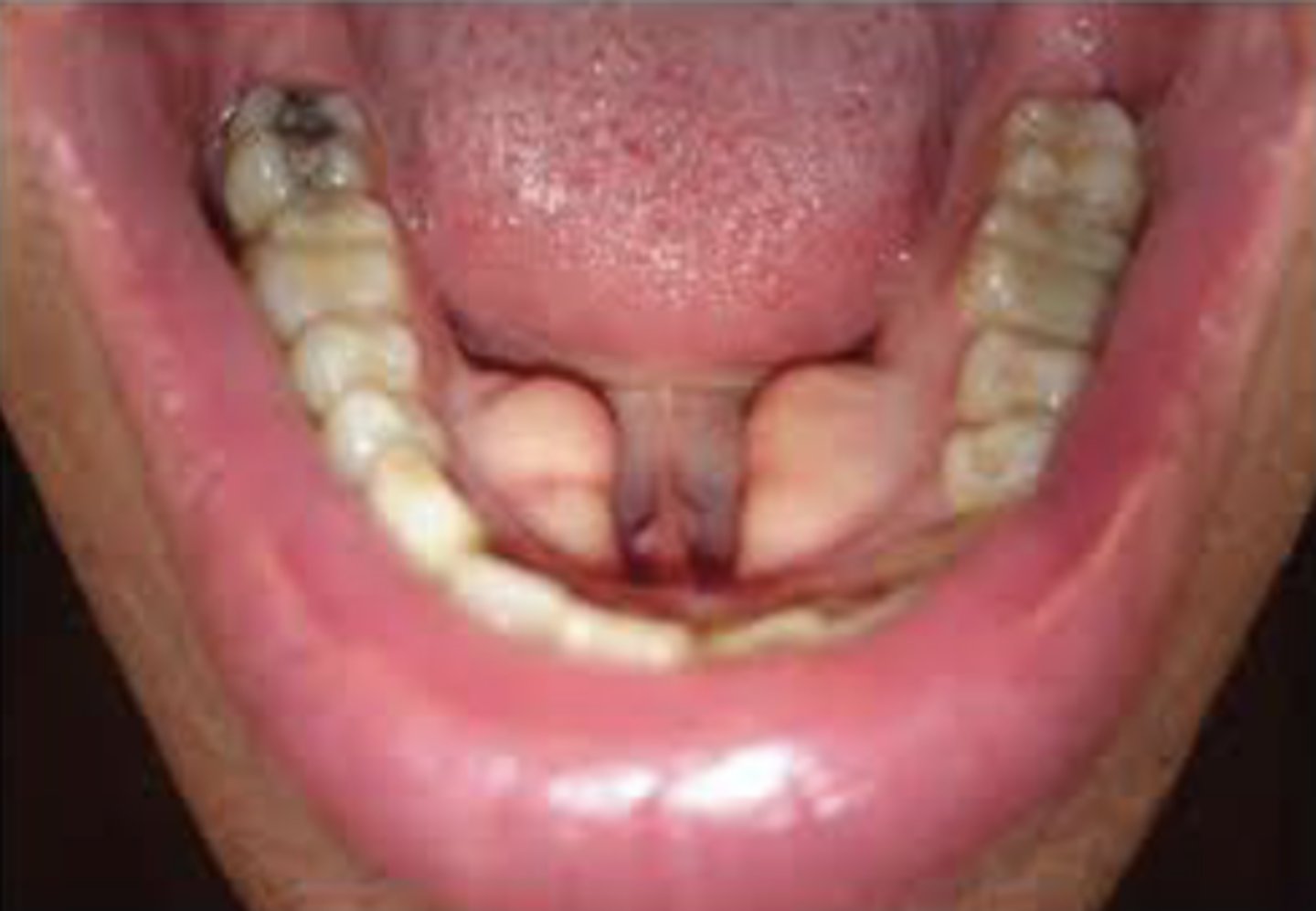 <p>Outgrowths of cortical bone</p>