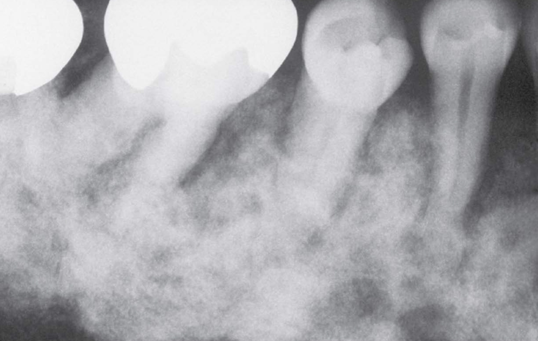 <p>Cotton roll  </p>