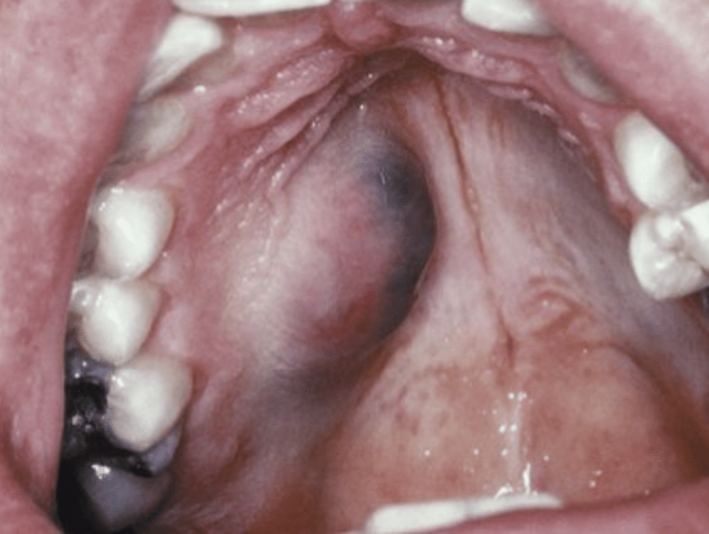 <p>Mucoepidermoid Carcinoma</p>