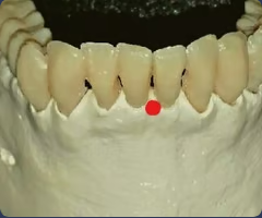 <p>Midline point at the superior tip of the septum between the mandibular central incisors</p>