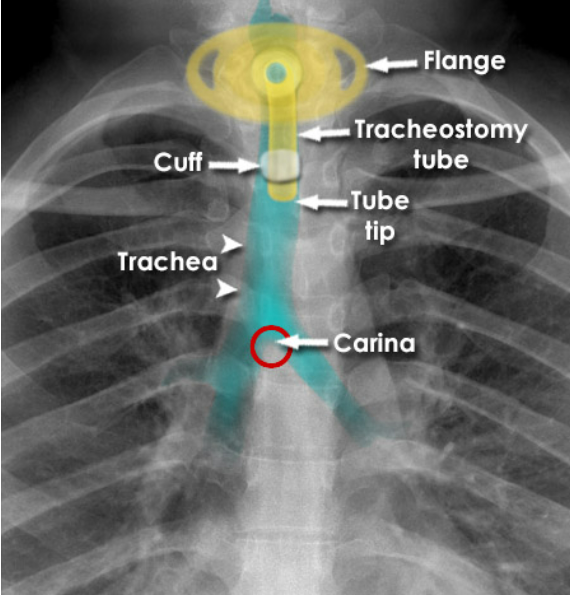 <p>To bypass upper airway obstructions such as cancer or burns, and establish a direct airway.</p>
