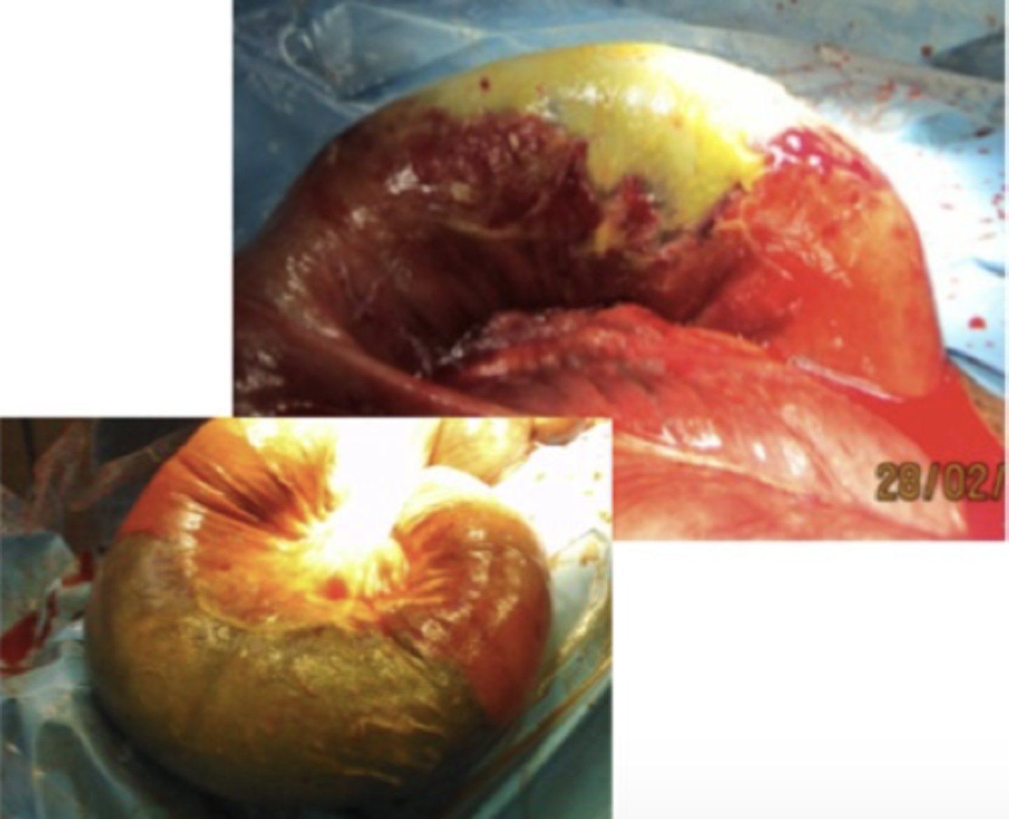 <p>Ved en eksplorativ laparotomi på en hest med kolik og peritonitis, findes denne læsion på Flexura Pelvina. Hvad er den mest sandsynlige årsag til dette?</p><p>- Neoplasi</p><p>- Obstruktion</p><p>- Trombo-embolisk infarkt</p><p>- Colitis</p>
