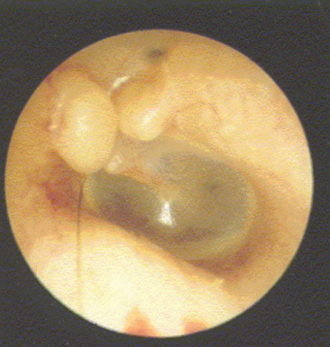 <p><u>disordered otoscopy: canal</u></p><p>exostoses</p>