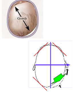 <p>Restrain the growth of the normal shape of the cranium by only allowing growth in the deformed areas. Providing the skull a symmetrical and/or proportional environment during rapid periods of growth. </p><ul><li><p>Control the growth during the final stages of rapid cranial growth, 4-6 months of age.</p></li></ul><p></p>