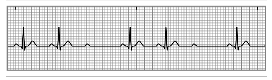 <p>is a condition characterized by sporadic failure of electrical impulses from the atria to the ventricles, usually resulting in some QRS complexes being dropped without a progressive change in PR interval length. </p>