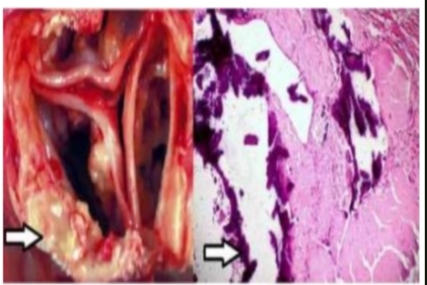<p>What type of tissue accumulation is shown and what are its macroscopic and microscopic appearances?</p>
