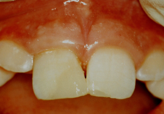 <p>resin placed over the surface of the tooth&nbsp;</p>