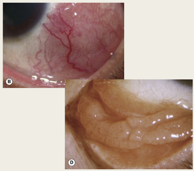 <p>irritation</p><p>painless swelling</p>
