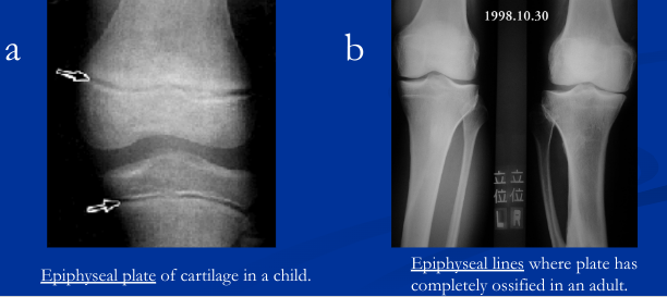 Bone lengthening ends because at puberty, the sex, growth, and thyroid hormones stimulate osteoblasts to produce bone faster than the chondroblasts can make cartilage.  Therefore, the epiphyseal plate gets thinner and thinner until it completely ossifies. The remnants of the epiphyseal plate can be seen as an ossified line called the epiphyseal line.