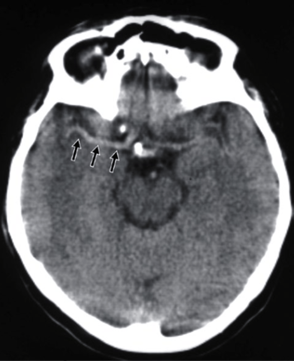 <p>what type of imaging is this?</p><p>a. CT scan</p><p>b. MRI with IV contrast</p><p>c. PET scan</p><p>d. Bone Scan</p>