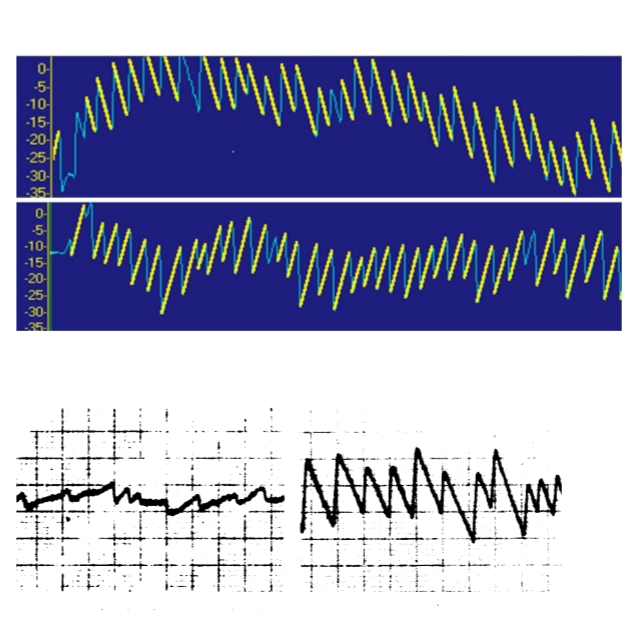 <p>Normaal: gladde oogbeweging in de richting van <br>het bewegend beeld, onderbroken door <br>terugslagsaccades (snelle nystagmusslagen)</p><p>&nbsp;Let op asymmetrie (links/rechts)</p><ul><li><p>Spontane nystagmus</p></li><li><p>Centrale pathologie (hersenstam, cerebellair, <br>cerebraal corticaal)</p></li></ul><p>!!Concentratiestoornissen<br>Leeftijd<br>Medicatie!!!</p>