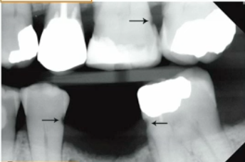 <p>what are these lesions?</p>