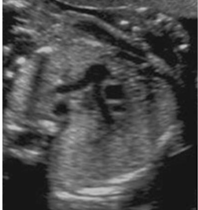 <p>where is the left pulmonary artery</p><ul><li><p>“branch closer to descending AO"</p></li></ul><p></p>