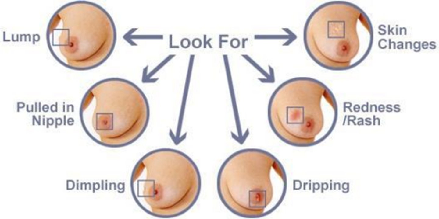 <p>Size >2cm, immobility, poorly defined/irregular margins, firmness, skin dimpling, nipple retraction, and bloody discharge.</p>