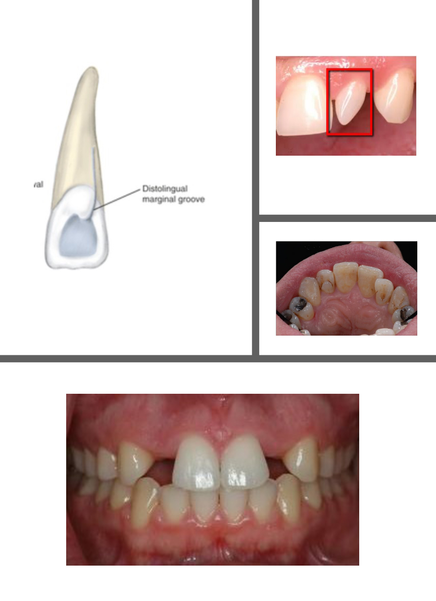 <p>Developmental Disturbances of Maxillary Lateral Incisors</p>