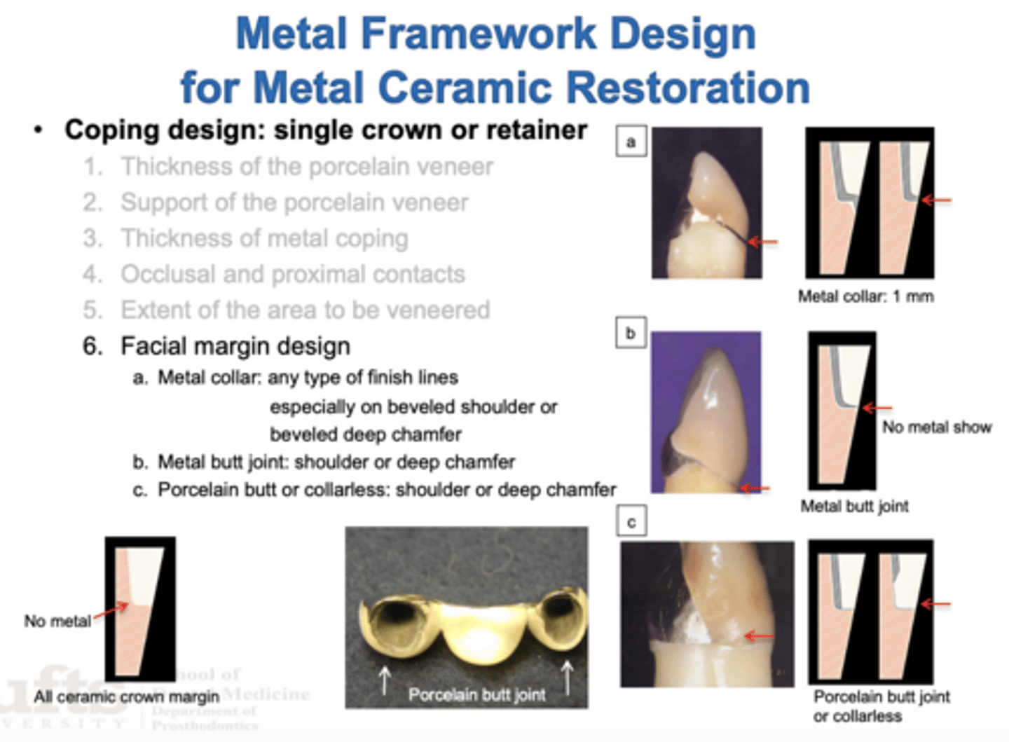 <p>- Metal collar</p><p>- Metal butt joint</p><p>- Porcelain butt joint or collarless</p>