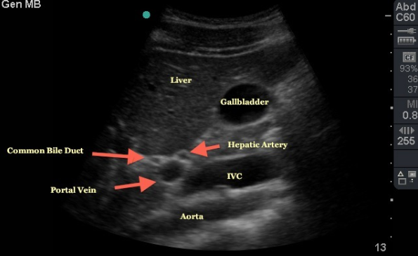 <ul><li><p><span>Portal vein</span></p></li><li><p><span>bile duct</span></p></li><li><p><span>hepatic artery</span></p></li></ul><p></p>
