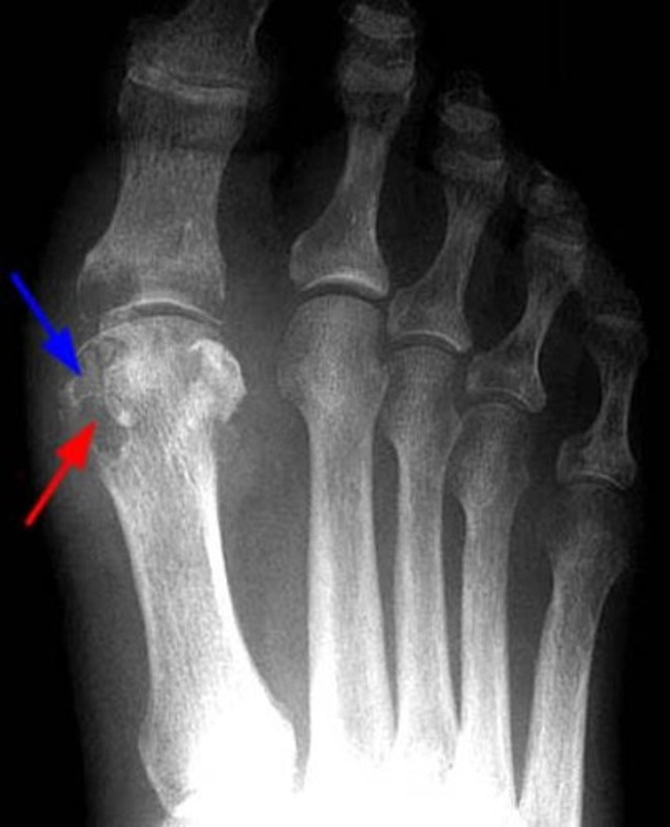 <p>inflammatory changes incited by deposition of calcium urate crystals in joint, most commonly metatarsal-phalangeal joint of great toe</p><p>- sharply marginated erosion w sclerotic border "rat bites"</p><p>- joint space narrowing</p><p>- tophi- collections of urate crystals</p><p>- olecranon bursitis</p>