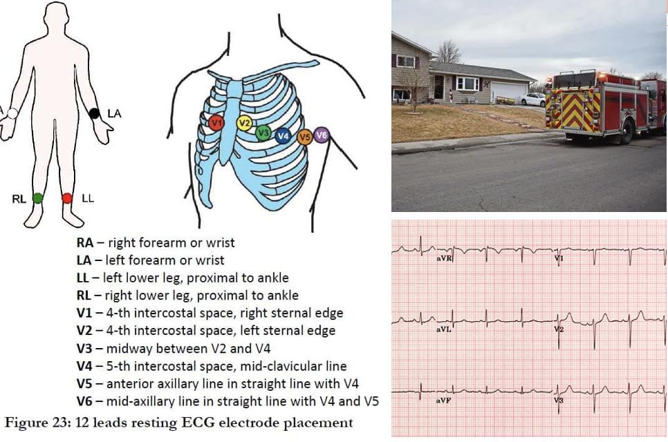 <ul><li><p>10 leads actually means 12 views.</p></li><li><p>The views look at the heart’s <mark data-color="yellow" style="background-color: yellow; color: inherit"><u>electrical activity</u></mark> from multiple angles.</p></li><li><p><strong>Changes</strong> must be <strong>noted</strong> in at <strong>least two contiguous leads (looking at the same part of the heart)</strong> to be considered clinically significant.</p></li></ul><p></p>