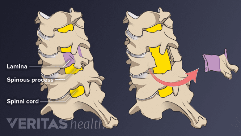 <p><span style="font-family: &quot;New York&quot;"><strong>Laminectomy &amp; placement of stabilizing rods</strong></span></p><p><br></p>