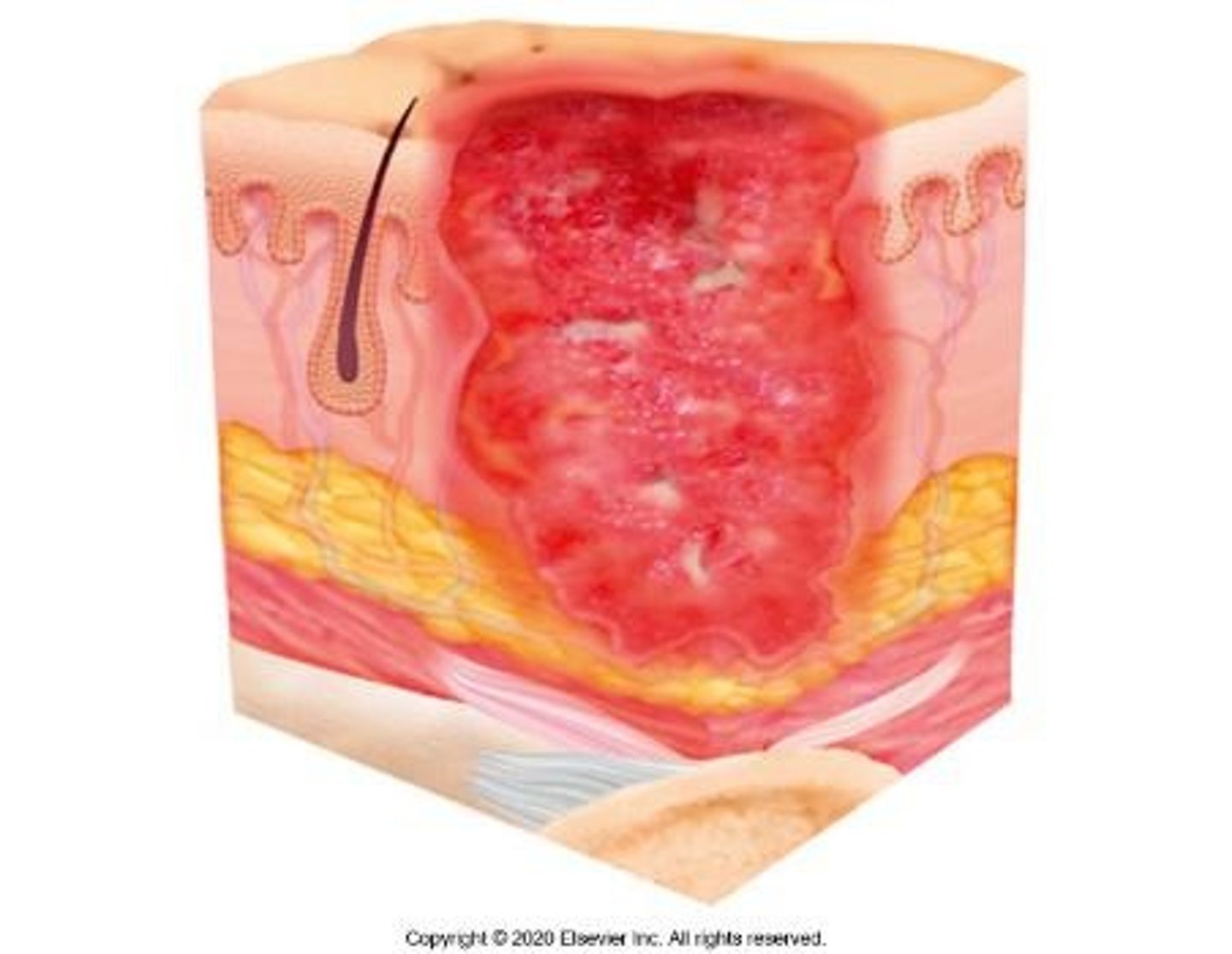 <p>Full-thickness skin loss; adipose tissue is visible.</p>