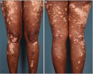 <p>asymptomatic depigmented macules and patches, milk or chalk white in color that lack clinical signs of inflammation</p><p>-lesions appear anywhere on the body, varying in size from a few mm to many cm</p>