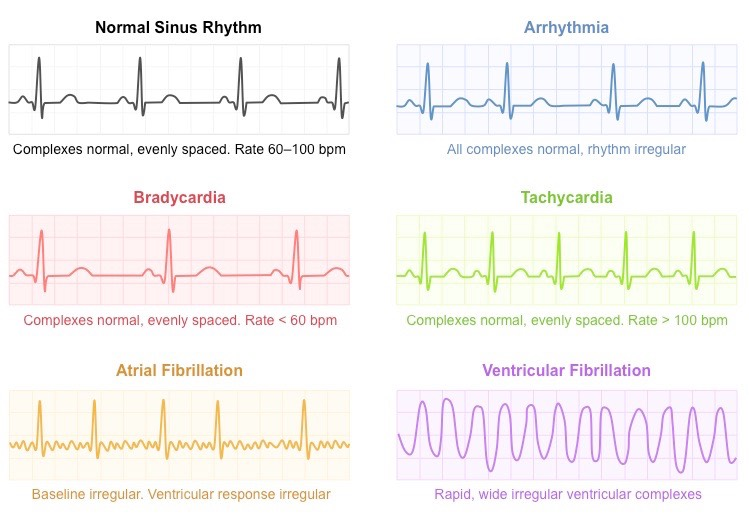 <ul><li><p><strong>Arrythmia</strong>: normal complexes &amp; irregular rhythm</p></li><li><p><strong>Bradycardia</strong>: normal complexes, evenly spaced rhythm &amp; rate < 60 bpm</p></li><li><p><strong>Tachycardia</strong>: evenly spaced complexes &amp; rate > 100 bpm</p></li><li><p><strong>Atrial fibrillation: </strong>irregular baseline &amp; clear ventricular response</p></li><li><p><strong>Ventricular fibrillation</strong>: rapid, wide irregular ventricular complexes</p></li></ul><p></p>
