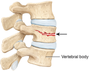 <p>The vertebral body of one or more vertebrae fractures and becomes compressed into a wedge-shape. May be caused by injury, trauma, or more commonly in individuals with osteoporosis.</p>