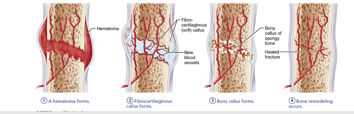 <p>1) Formation of a hematoma – local bone cells are deprived of oxygen and die; inflammation causes pain.</p><p>2) Formation of a fibrocartilaginous callus (soft) – invaded by blood vessels that also bring macrophages to clean up the area; osteoclasts also resorb damaged bone; fibroblasts, chondroblasts, osteoblasts get busy laying down collagen fibers and tissue components to span the break</p><p>3) Conversion to bony callus – cartilage converted to trabecular bone – complete in ~2 months</p><p>4) Bone remodelling – any extra bony material is removed; outer bone of shaft walls converted to compact bone and bone regains original shape</p><p>Final structure resembles original structure</p><p><span data-name="black_small_square" data-type="emoji">▪</span> Responds to same mechanical stressors</p>