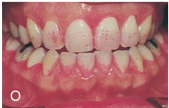 <ul><li><p>a type of enamel dysplasia</p></li><li><p>develops during apposition stage</p></li><li><p>results from a reduction in the <strong>quantity </strong>of the enamel matrix</p></li><li><p>teeth appear with pitting and grooves in the enamel surface or in the development of horizontal lines across the enamel of the crown</p></li><li><p>noted in the presence of Hutchinson incisors and mulberry molars</p></li></ul><p></p>