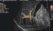 <p>Color aliasing is seen in the portal vein and its branches. </p><p>The screen reads that velocity scale is at 2 cm/s.</p><p>What should be done to correct this issue?</p>