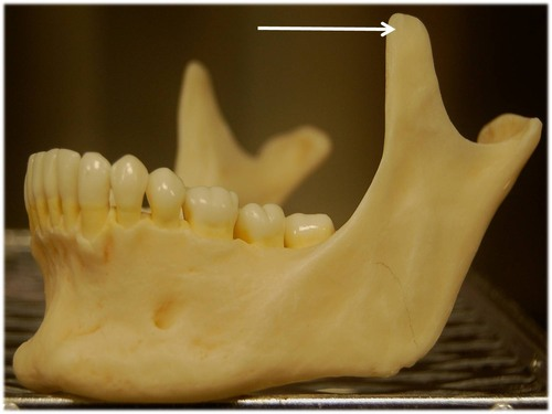 <p>Jutting anterior portion of the ramus; site of muscle attachment</p>