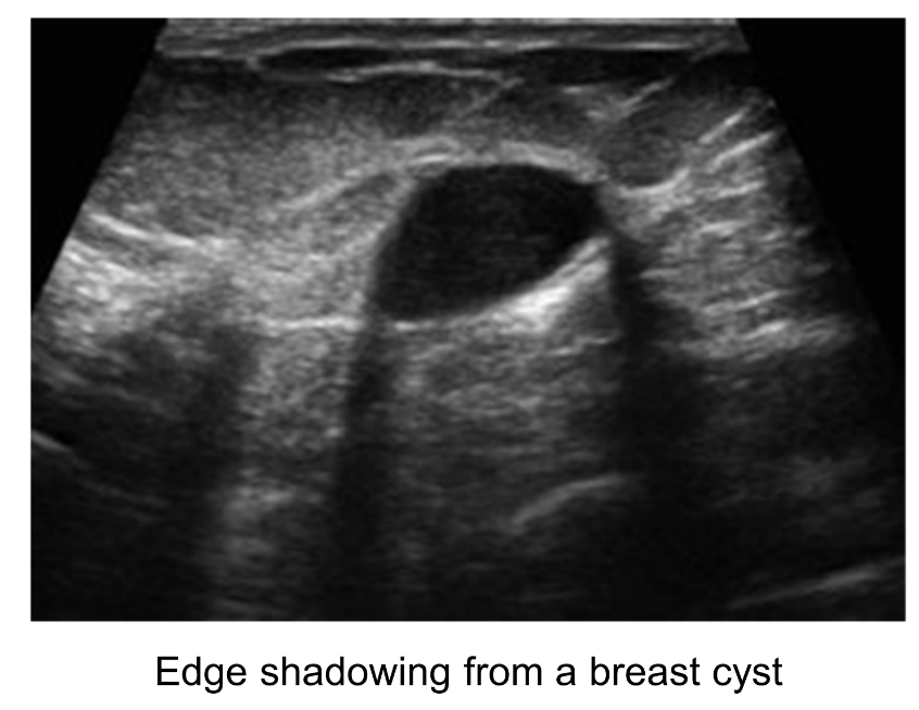 <p>Edge shadows at the edges of curved interfaces. It is very common. </p>