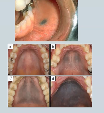 <ol><li><p>Amalgam Tattoo - deposits of fine flecs of amalgam - radiopacities </p></li><li><p><strong>Drugs </strong>– hydroxychloroquine, imatinib </p></li></ol><p></p>