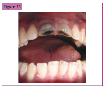 <p>_________upper central incisors following _________.</p>