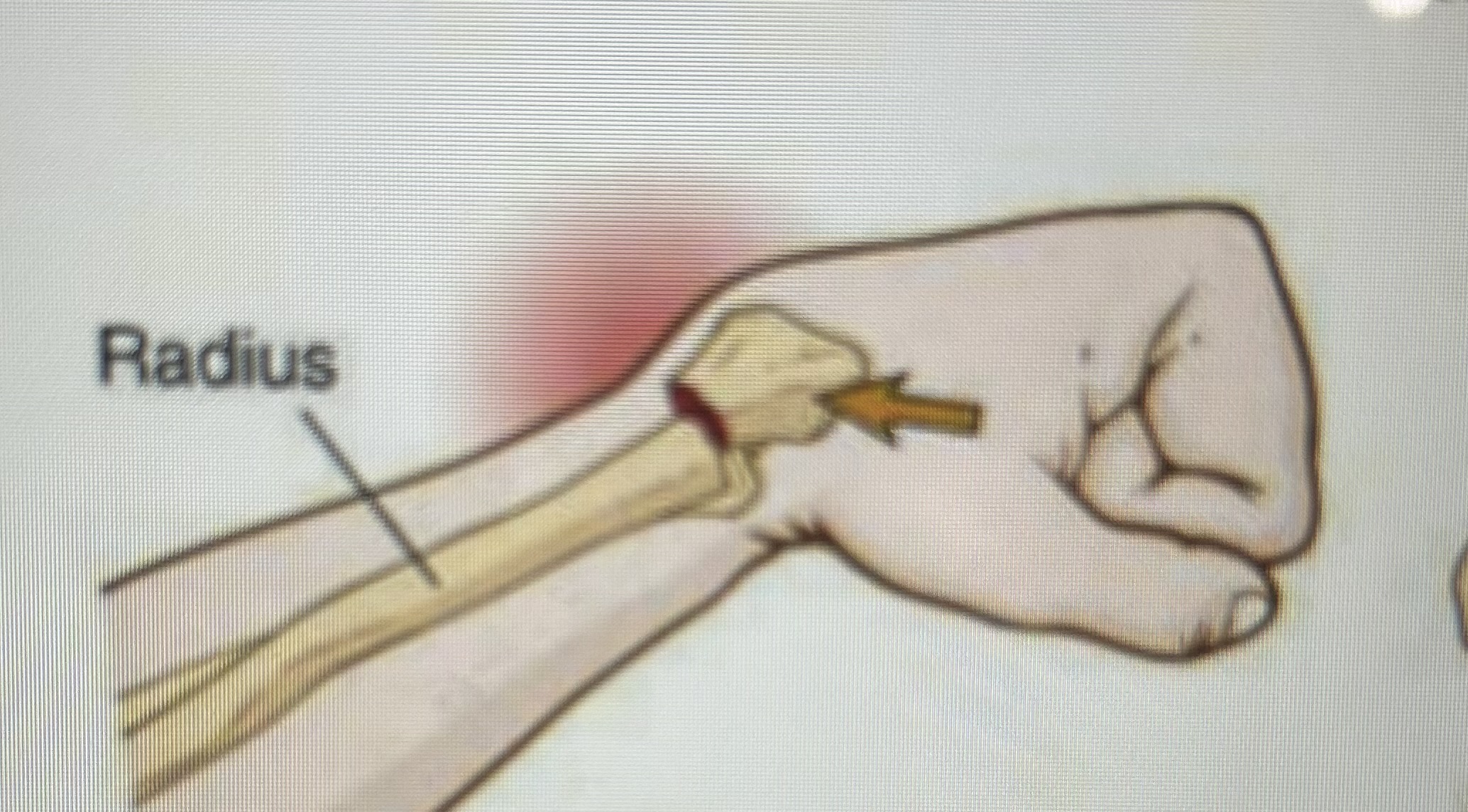 <p>What type of fracture is this?</p>