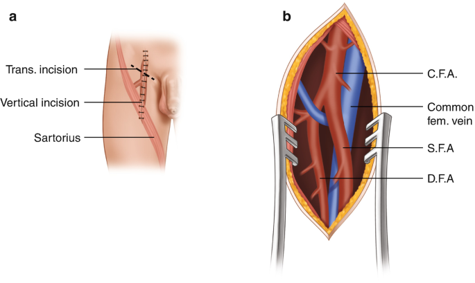<p>b) Inguinal groin to knee joint</p>