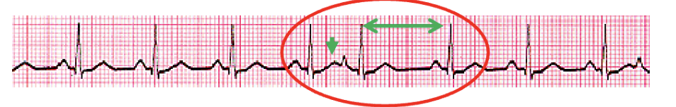 <p>Which premature complex has a P wave that is hidden in the ST-T wave of the preceding beat, producing a camel wave? </p>