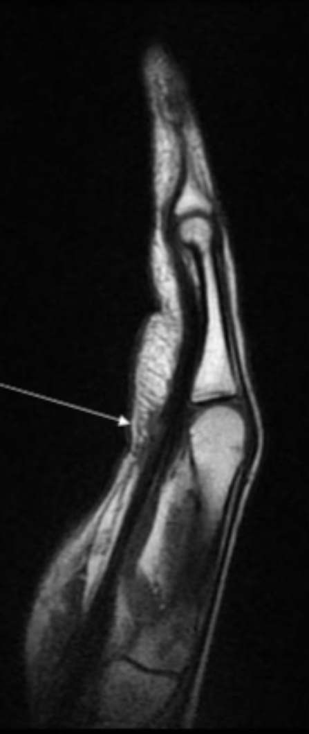 <p>Describe the pathology indicated by the arrow (Sag PD). </p>