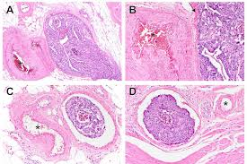 <p>Look for clusters of tumor cells that have crossed the Basement Membrane into the Stroma.</p>