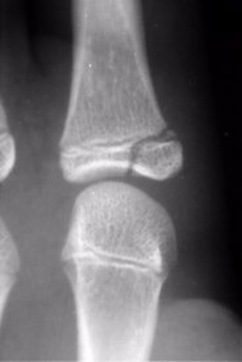 <p>Salter Harris grade?</p>