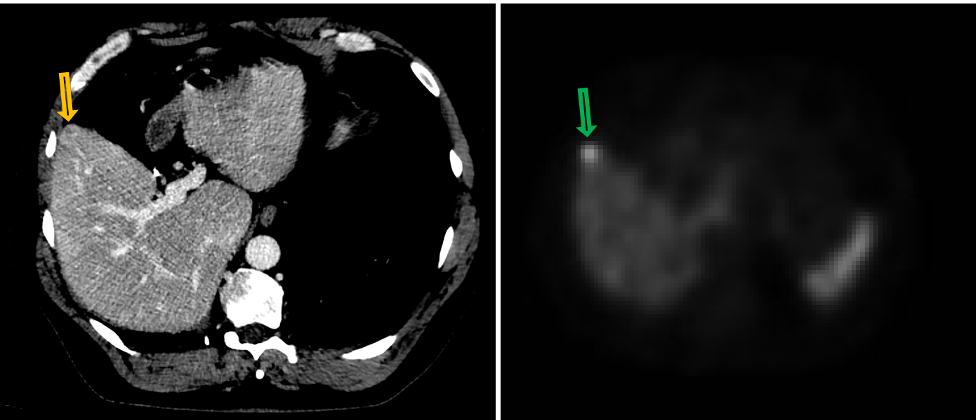 <p>Patient history: follow-up studies of a patient under treatment of small bowel neuroendocrine tumor </p><p>Modality: left–contrast enhanced venous phase, soft tissue window (iv. iodine-based contrast agent); right– SPECT (applied radiopharmacon: Tektrotyd Tc-99m) </p><p>Region: upper abdomen, axial views </p><p>Radiologic sign: Small-sized, intensively enhancing ring-like, circumscribed lesion that can be hardly suspected in the right lobe of the liver (yellow arrow). At the same location SPECT shows increased radiopharmacon uptake (green arrow). </p><p>Diagnosis: liver metastasis of small bowel neuroendocrine tumor</p>