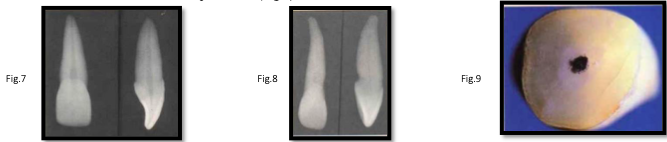 <p>canal anatomy of <strong>mx incisors</strong></p>