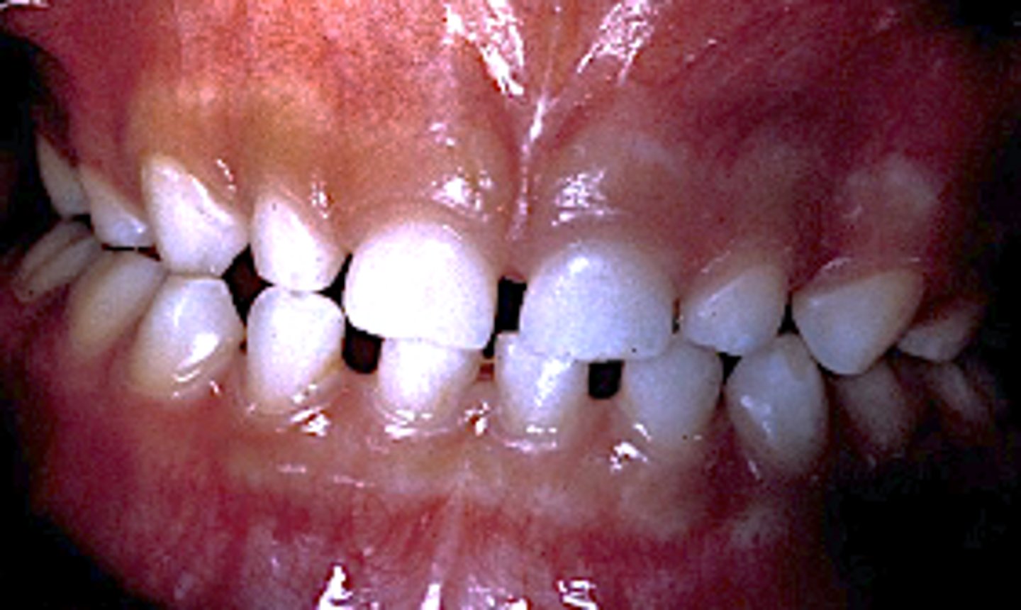 <p>ID the Baume Type:</p><p>- With interdental spaces between the anterior teeth</p><p>- The length and width of the dental arches (during the period of the primary dentition) remain unchanged</p><p>- Both the mandible and maxilla are growing in length distally to accommodate the developing permanent molars</p>