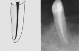 <p><span>Single canal from pulp chamber to apex</span></p><p><span>1</span></p>