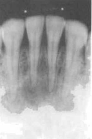 <p>teeth remain<span style="color: red;"><span> vital</span></span></p><p>no treatment needed</p><p>appears as a<span style="color: red;"><span> radiolucent</span></span> area</p><p>develops<span style="color: red;"><span> slowly</span></span> over <span style="color: red;"><span>about 6 years</span></span></p><ul><li><p><strong>commonly found near:</strong></p></li><li><p>MN incisors</p></li></ul><p></p>