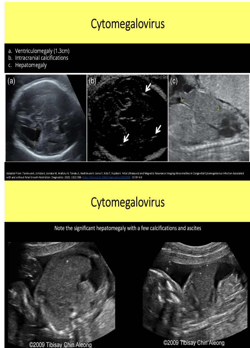 <p>c) cytomegalovirus infection</p>