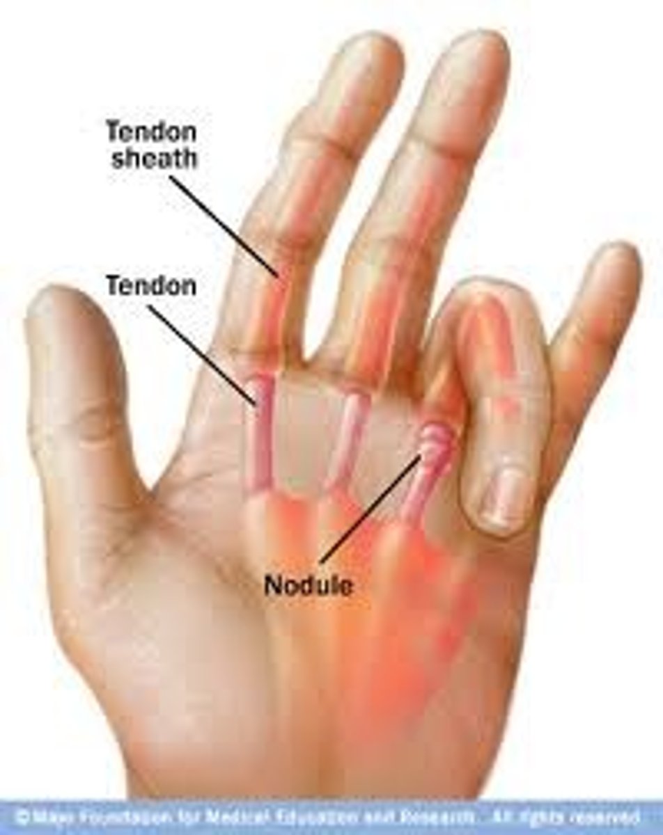 <p>- results of a thickening of the flexor tendon sheath (notta's nodule), which causes sticking of the tendon when the patient attempts to flex the finger</p><p>- a low-grade inflammation of the proximal fold of flexor tendon leads to swelling and constriction in digital flexor tendon</p><p>-when patient attempts to flex the finger, the tendon sticks, and the finger "let's go," often with a snap.</p><p>- as condition worsens, eventually finger will flex but not let go, and it will have to passively extended until finally a fixed flexion deformity occurs.</p><p>***usually occurs in 3rd or 4th finger</p><p>****most often associated with RA and tends to be worse in the morning.</p>